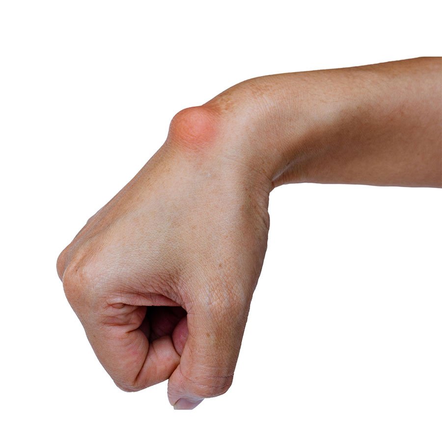 Cyst Removal Procedure