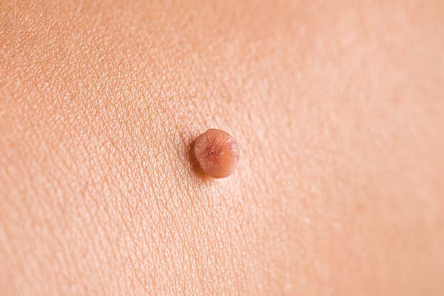Skin Tag Removal Treatment