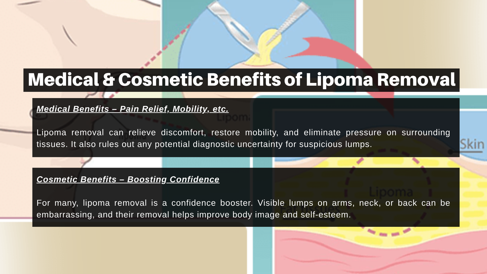 Medical & Cosmetic Benefits of Lipoma Removal