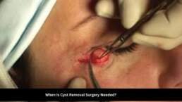 Cyst removal surgery before and after