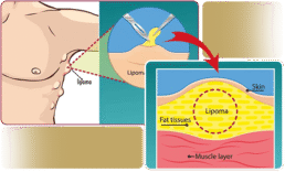 Lipoma Removal Procedures (MECE Breakdown)