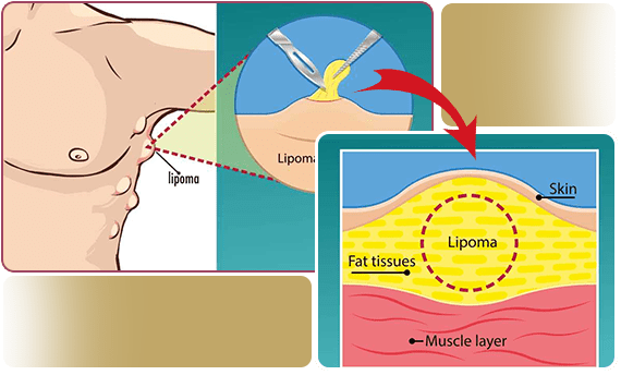 Lipoma Removal Procedures (MECE Breakdown)