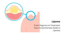 lipoma diagnosis and evaluation