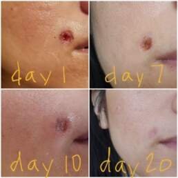 Mole Removal Procedure