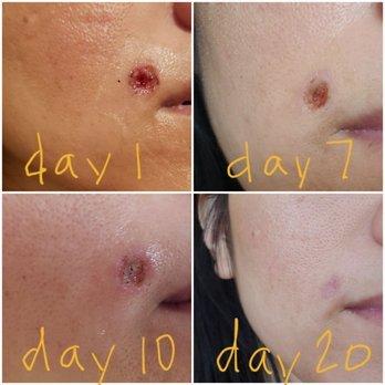Mole Removal Procedure
