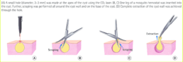 Different Types of Cyst Removal Procedures
