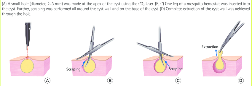 Different Types of Cyst Removal Procedures