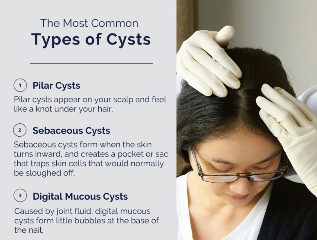 Types of Cysts