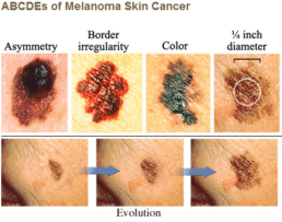 Types of Moles at Eldon Aesthetic