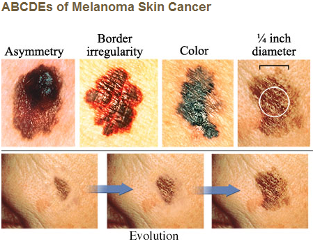 Types of Moles at Eldon Aesthetic