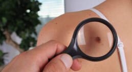 mole removal diagnosis and evaluation