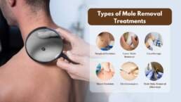 Moles Removal Surgery Options