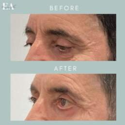 Lower eyelid surgery