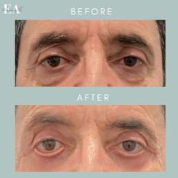 Upper eyelid surgery