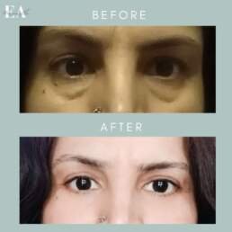 Lower Eyelid Surgery Before and After