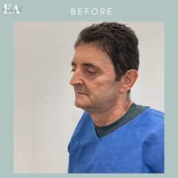 before upper eyelid surgery