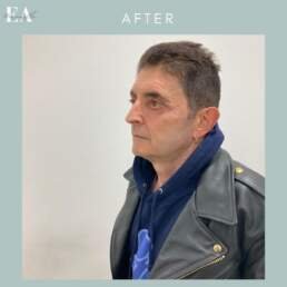 After upper eyelid surgery