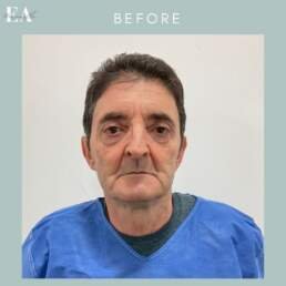 Before lower eyelid surgery