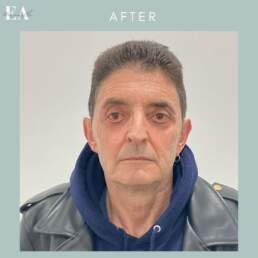 After Lower eyelid surgery