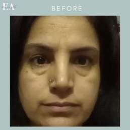 Lower Eyelid Surgery Before