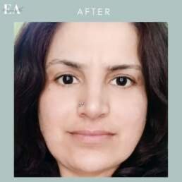 Lower Eyelid Surgery after