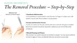 The Removal Procedure – Step-by-Step