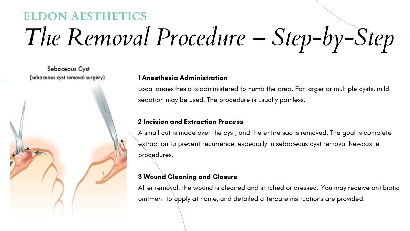The Removal Procedure – Step-by-Step