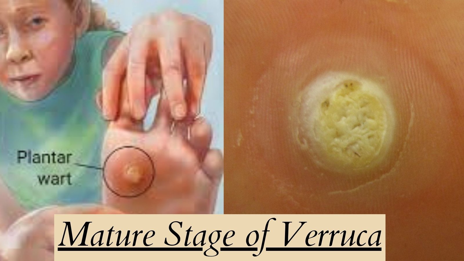 Mature Stage of Verruca