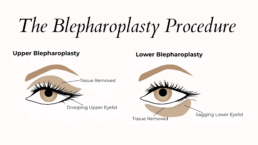 Blepharoplasty cosmetic surgeryProcedure