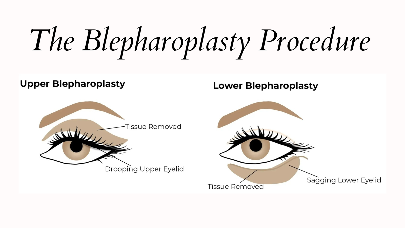 Blepharoplasty cosmetic surgeryProcedure
