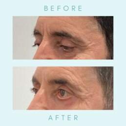 lower eyelid surgery before and after