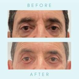 upper eyelid surgery before and after