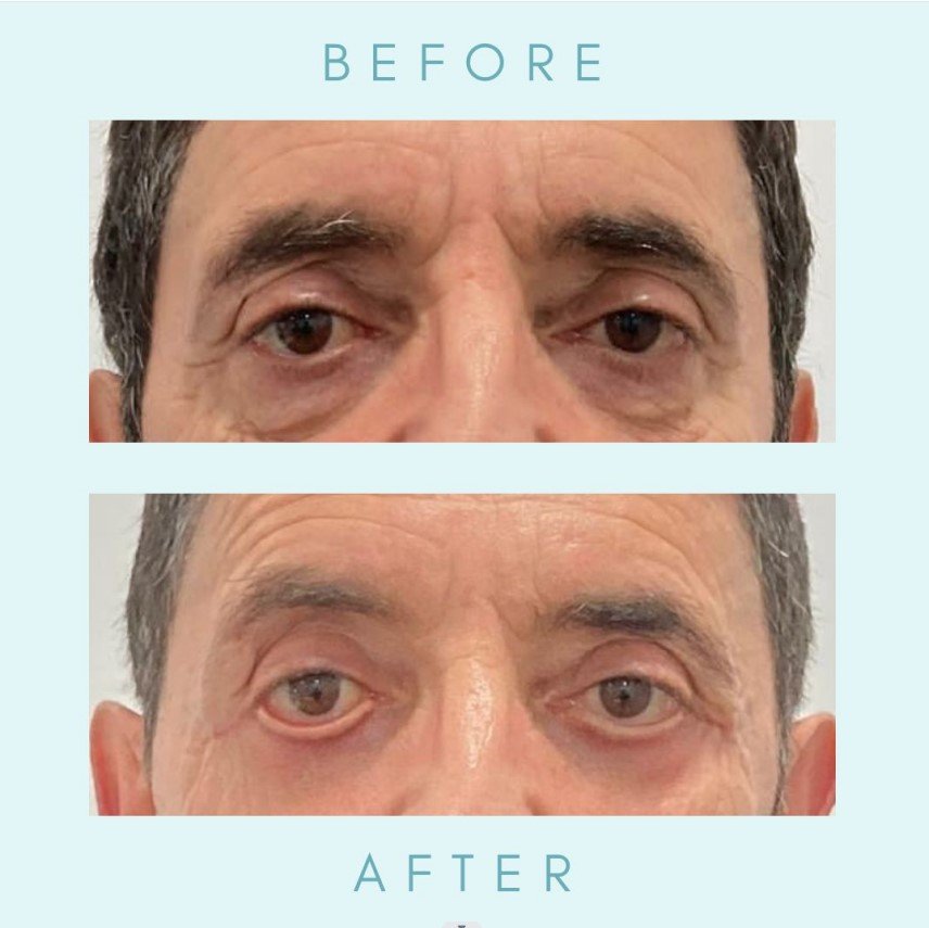 Blepharoplasty Eyelid Surgery