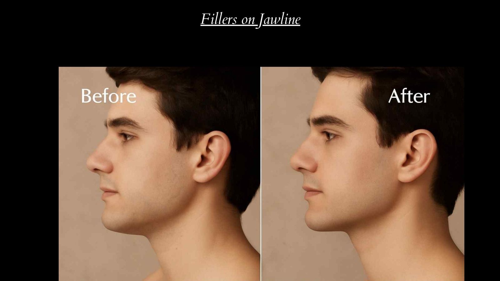 Fillers on Jawline: Guide to a Defined Look For Men