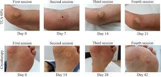 Stages of Verruca : Early to Dying Phases Explained