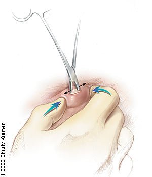 Taking Out a Cyst: Safe Methods, Risks & Recovery Tips