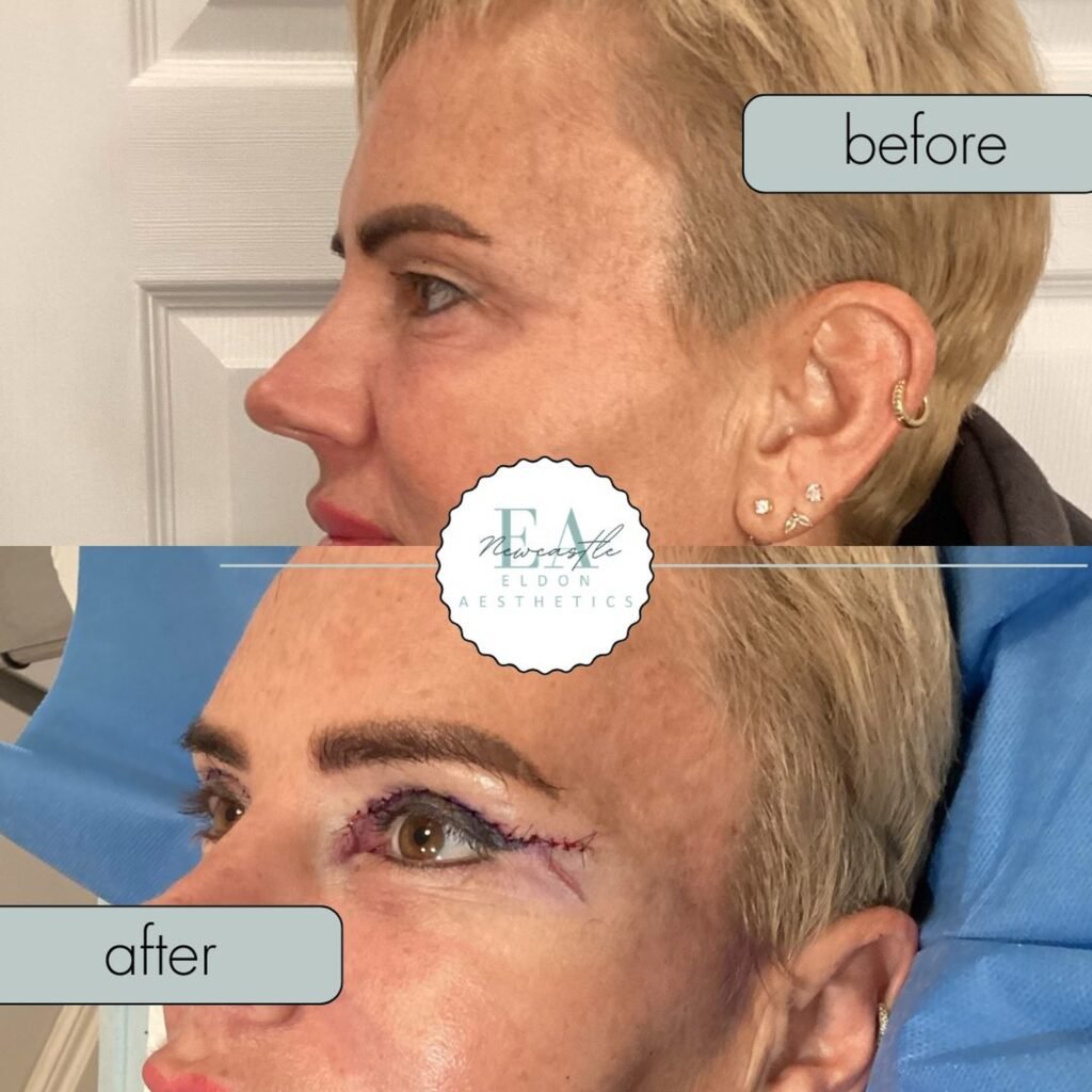 eyelid surgery before and after