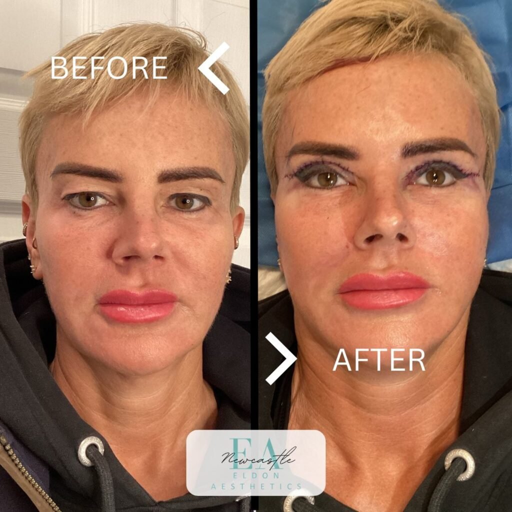 Upper Bhlepharoplasty