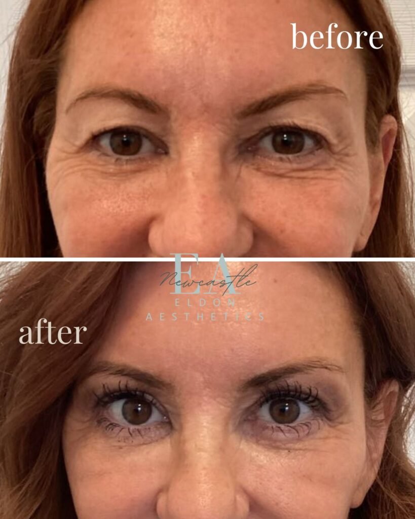 bleph-eyelid-surgery-Newcastle