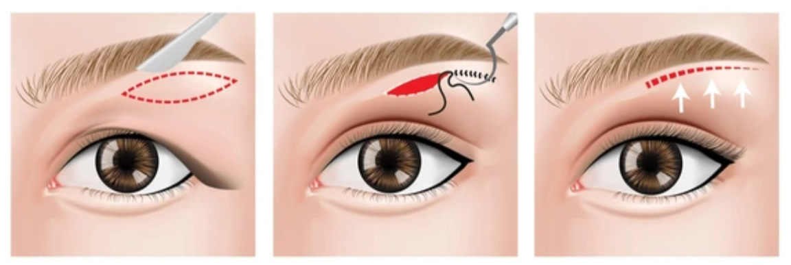 direct brow like procedure