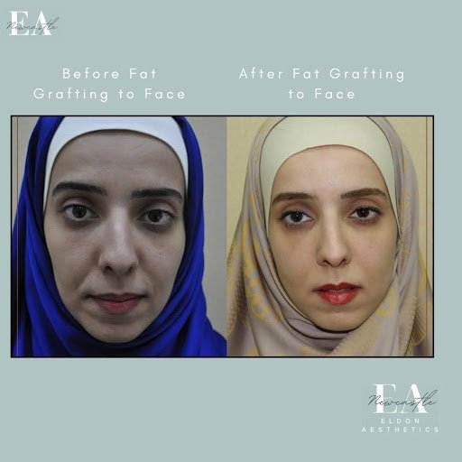Before & after fat grafting to face
