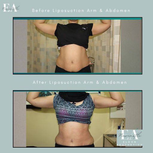 Before & after liposuction arm & abdomen