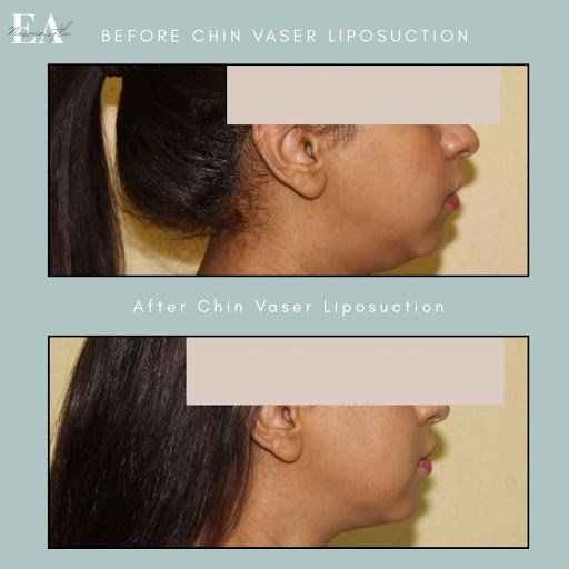 Before & after chin vaser liposuction