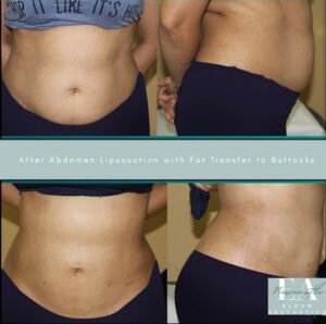 Liposuction Surgery and Fat Reduction
