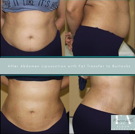 Liposuction Surgery and Fat Reduction