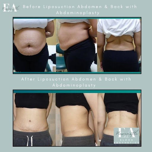 Before and After Liposuction abdomen & back with abdominoplasty