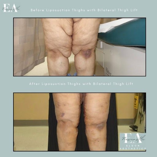 Before & after liposuction thighs with bilateral thigh lift