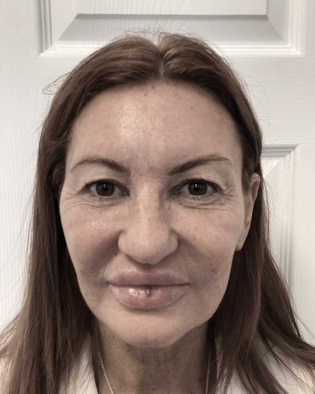 Before blepharoplasty
