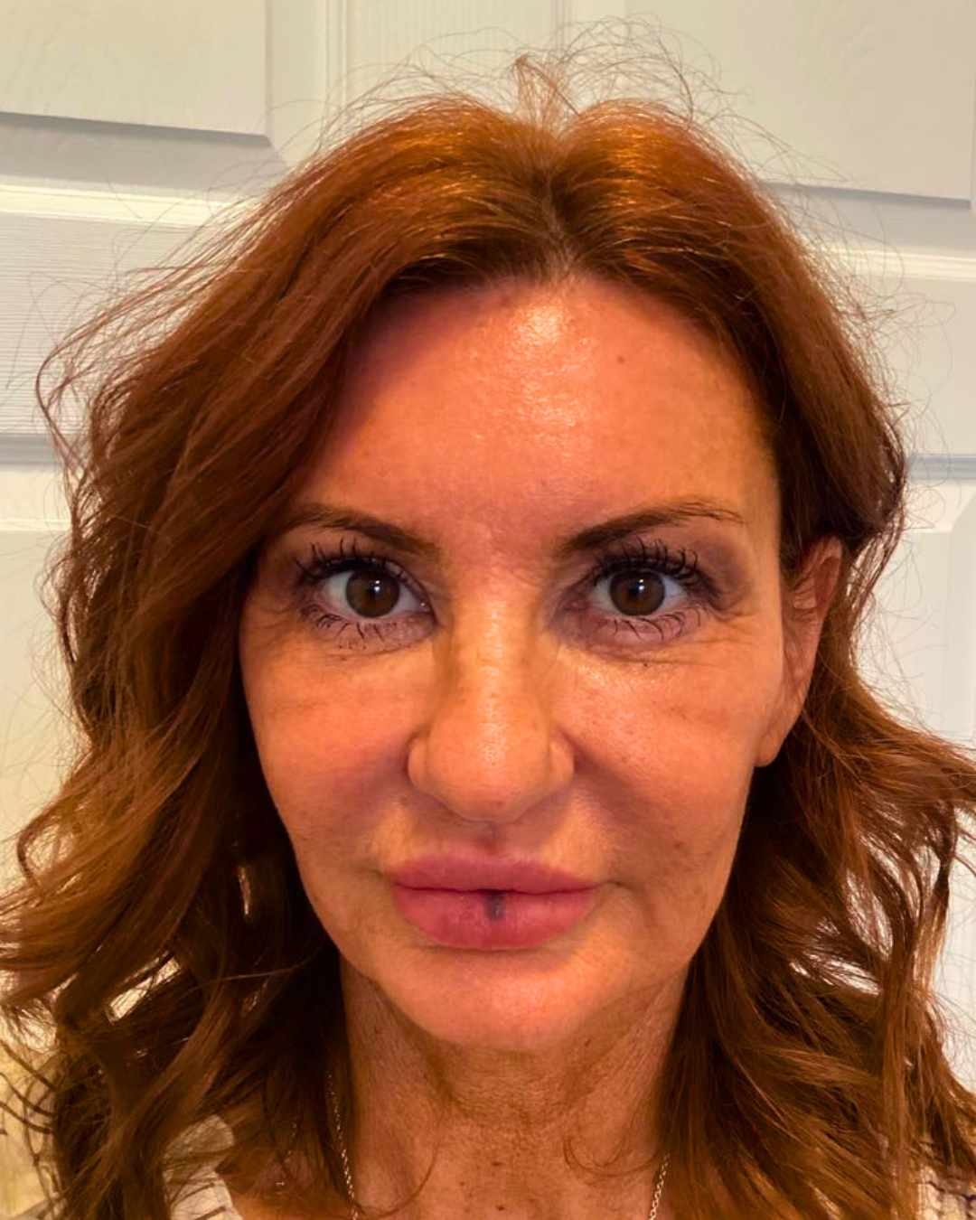 after blepharoplasty